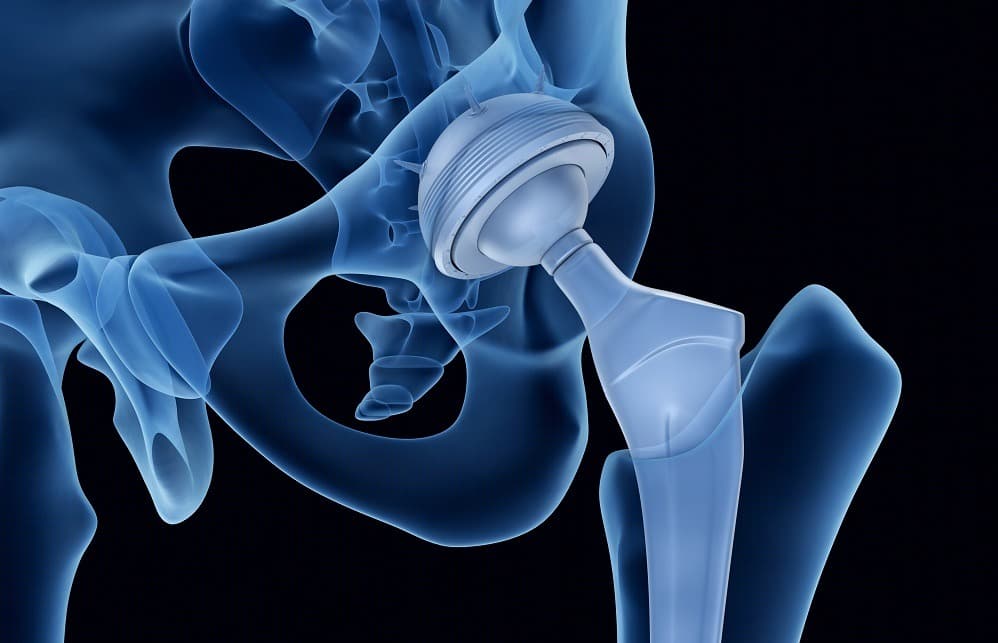 Types of hip replacement