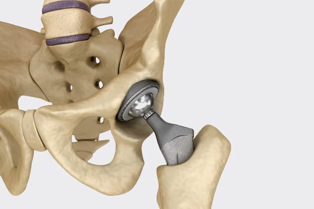 Why Is Hip Replacement Surgery Done?