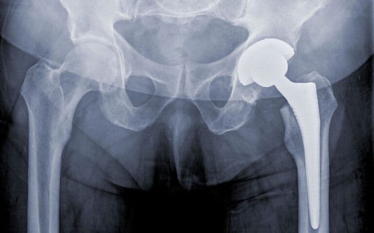 Hip arthroplasty candidate