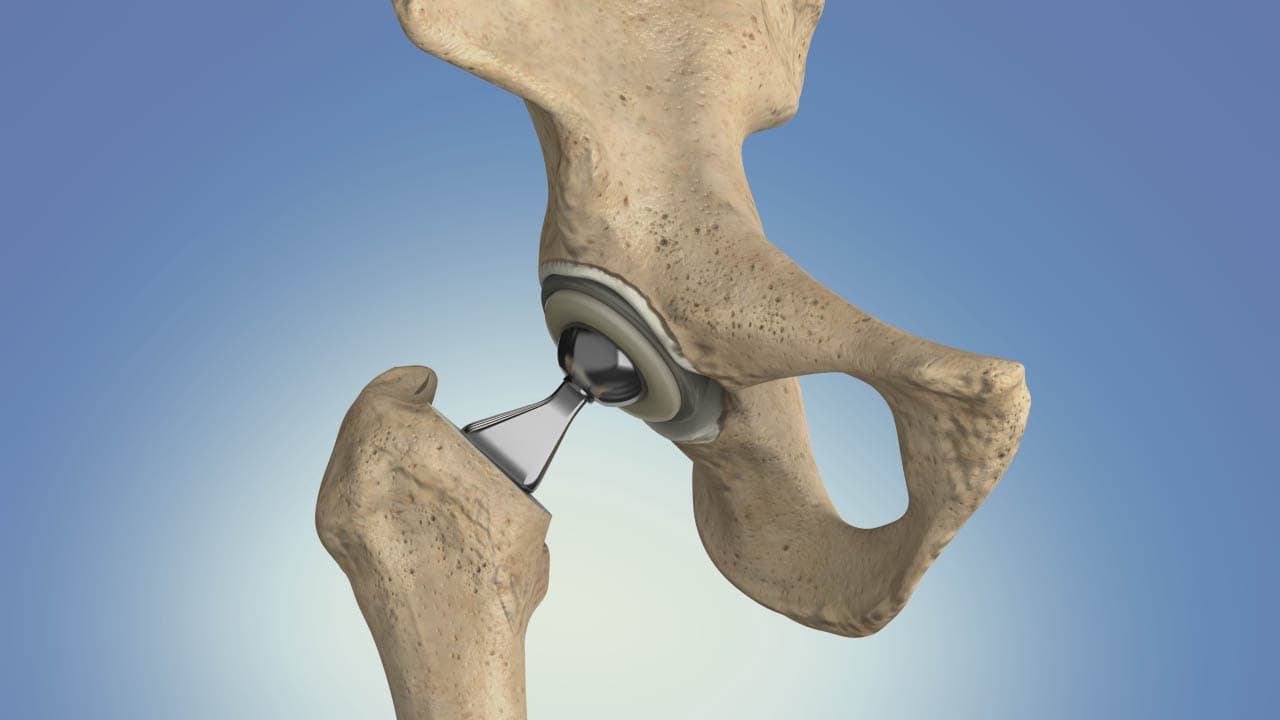 Total Hip Replacement Materials