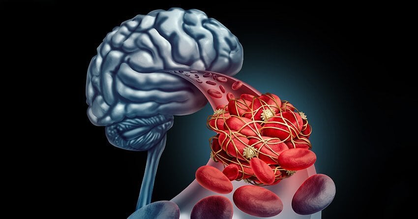 What is cerebrovascular disease?