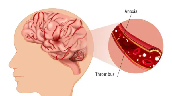 How is cerebrovascular disease treated?