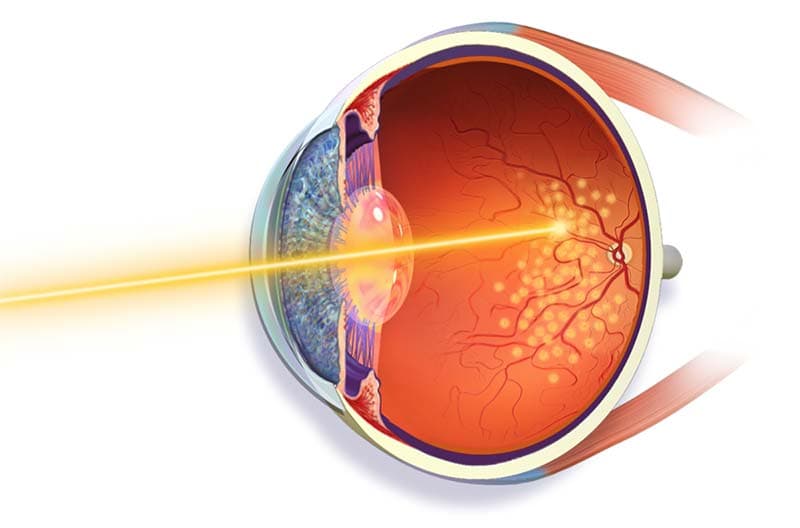 What is Retinal tear?