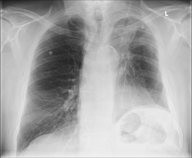 What are the Types of Lobectomy?