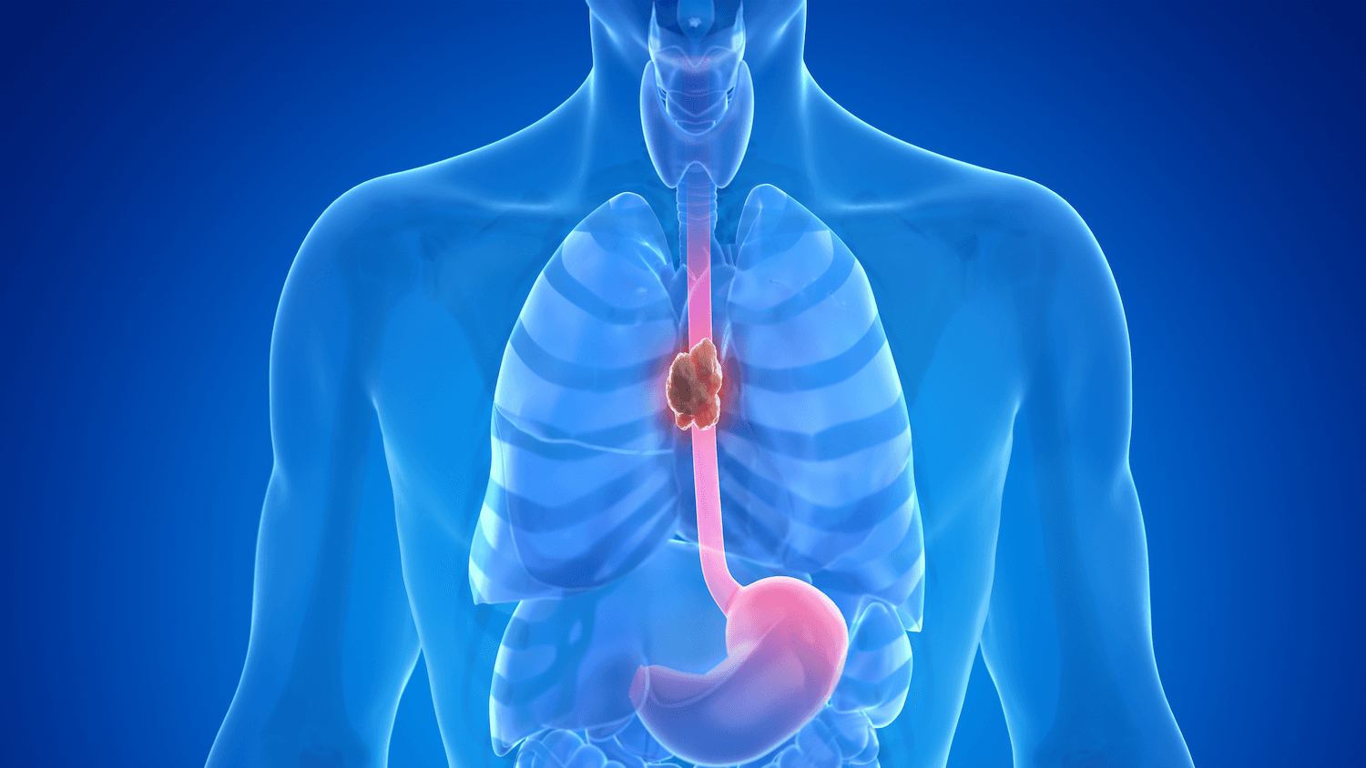 What Are Common Esophagectomy Complications?