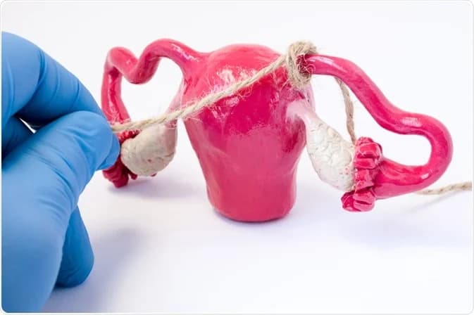 What are the benefits of female sterilization?