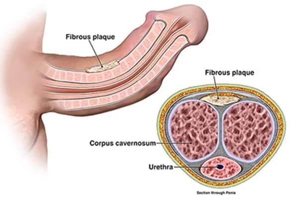 How is an Urethroplasty Performed?