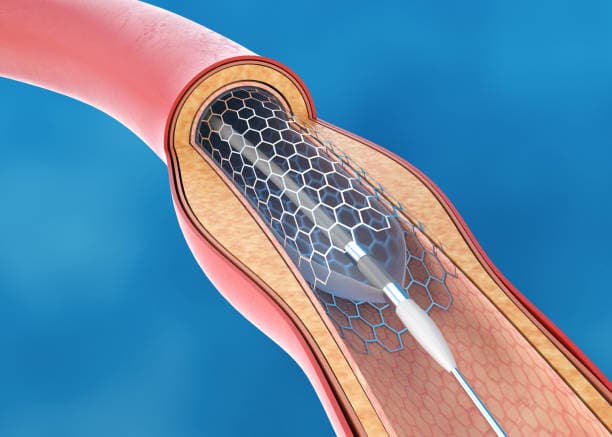 What is Angioplasty?