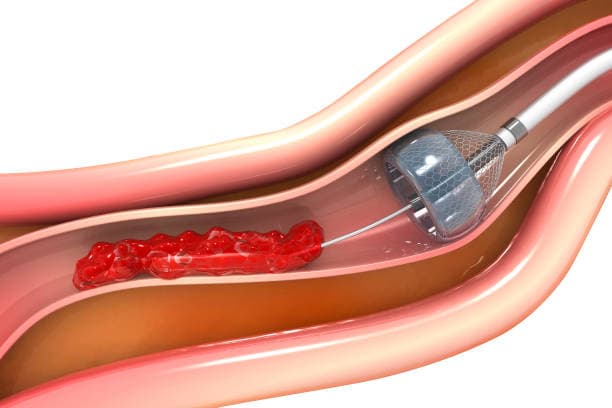 Angioplasty risks & benefits