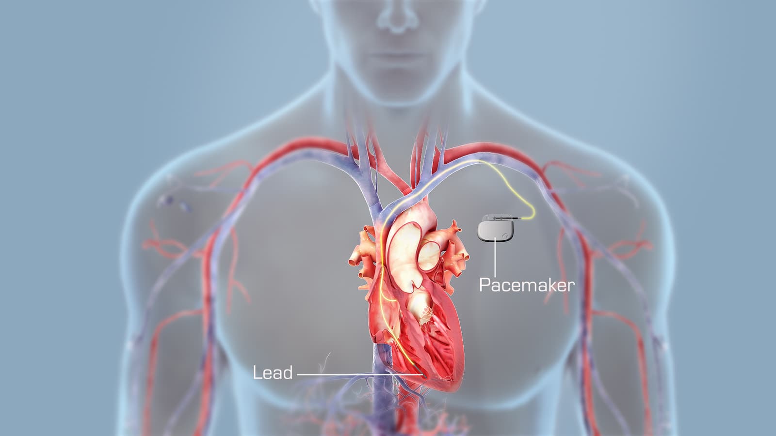 What are the different types of pacemakers?