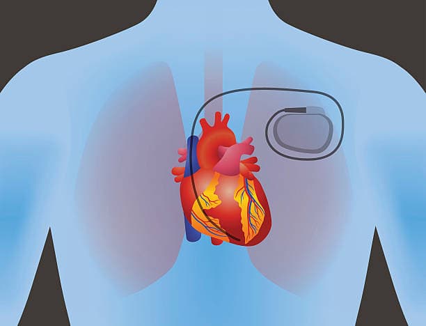 What are the special precautions following pacemaker implantation?