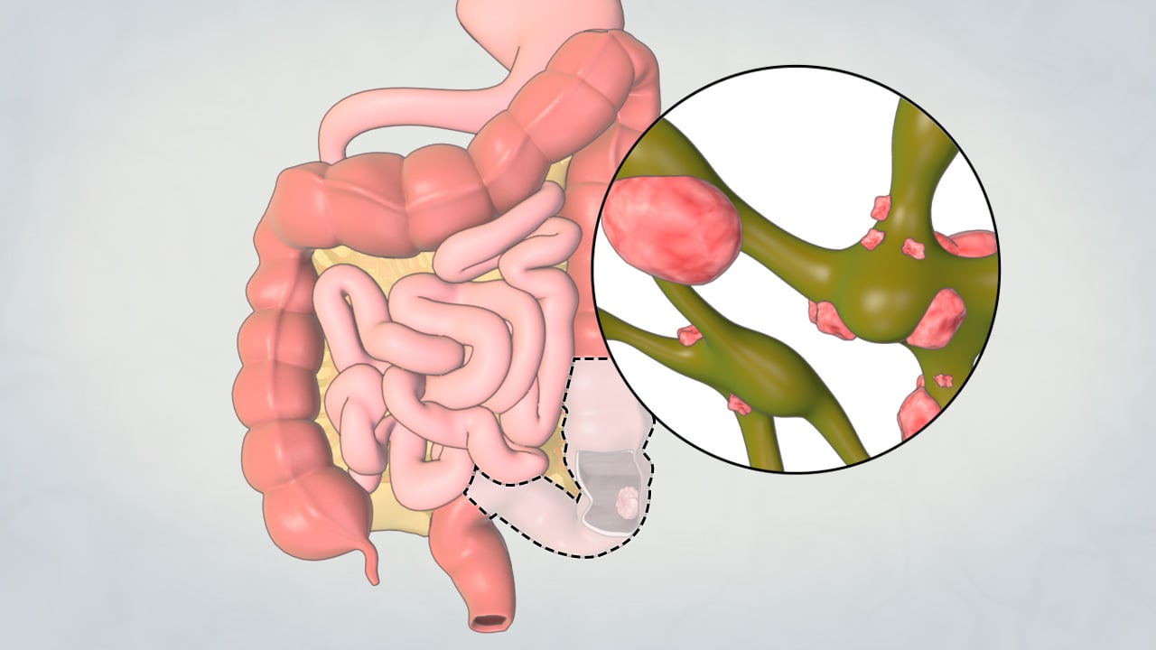 What you need to know about colon resection surgery?