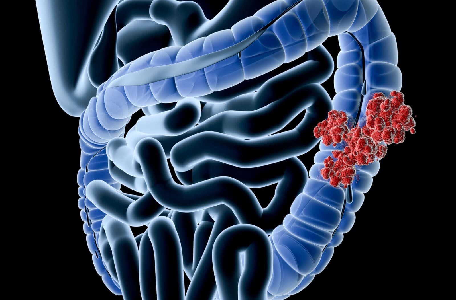 What is a Colectomy?