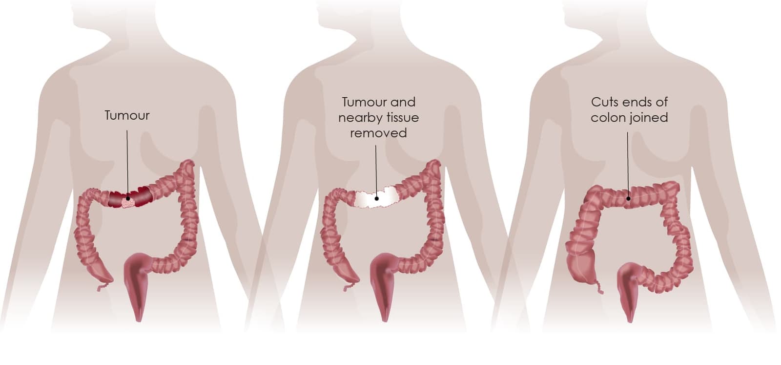Colectomy recovery process