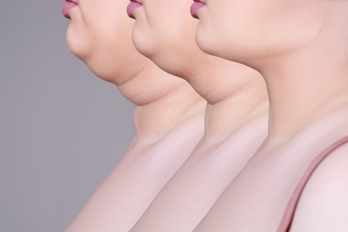 Double chin suction benefits
