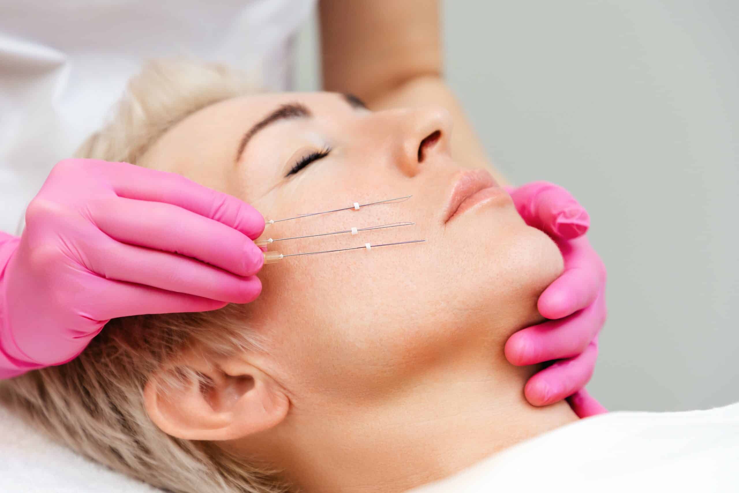 What does a Facial Thread Lift involve?