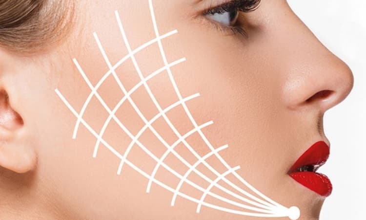 Who’s a good candidate for a thread lift?