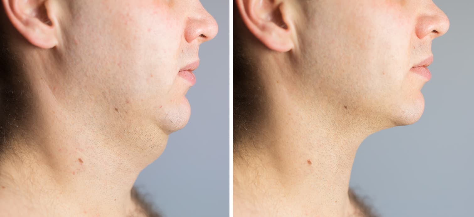 What is a neck lift?