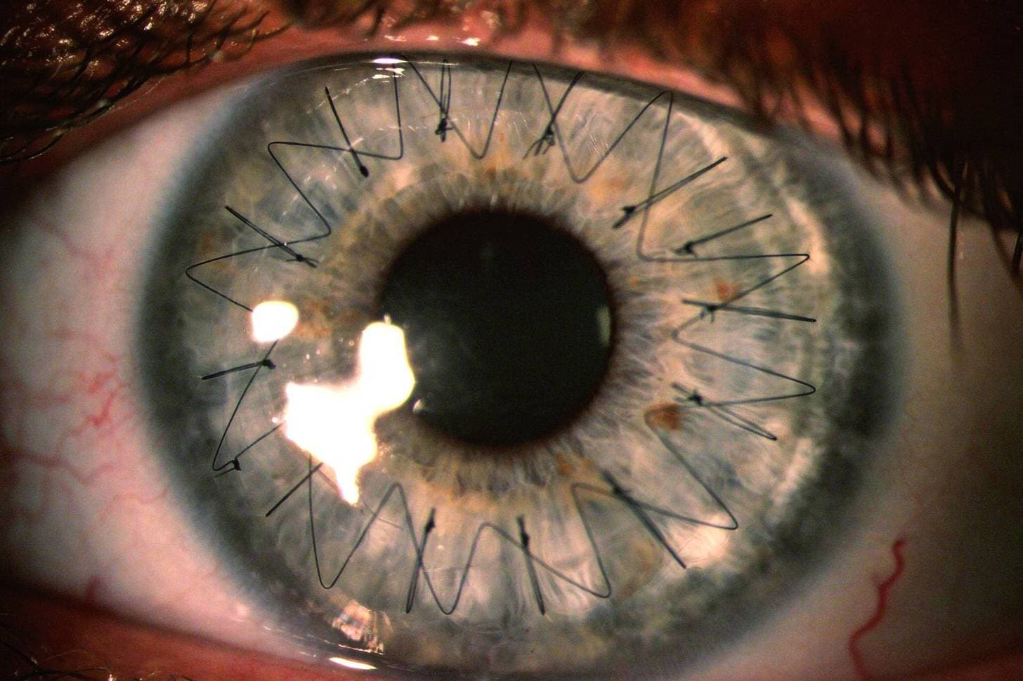 What are the risks & complications of cornea transplant?