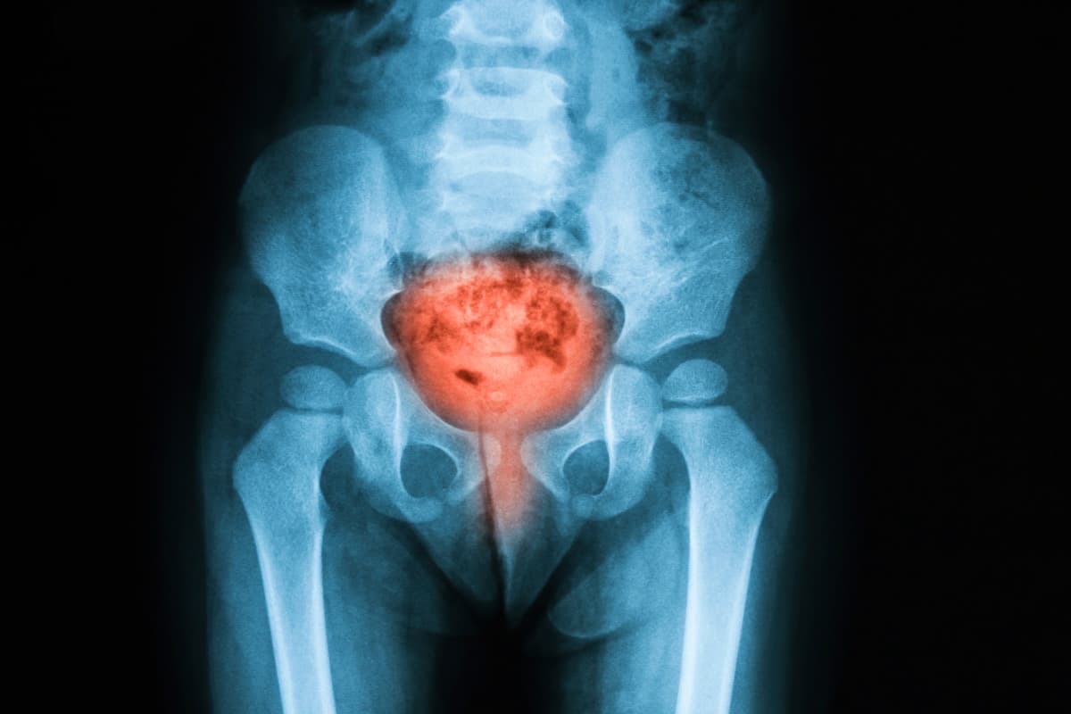 What are the causes of urinary tract infections?