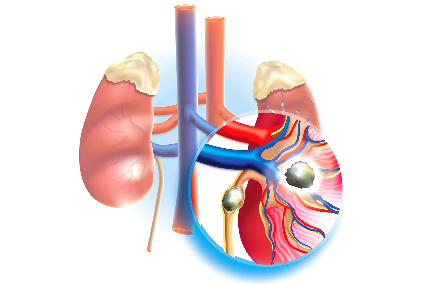 What are kidney stones?