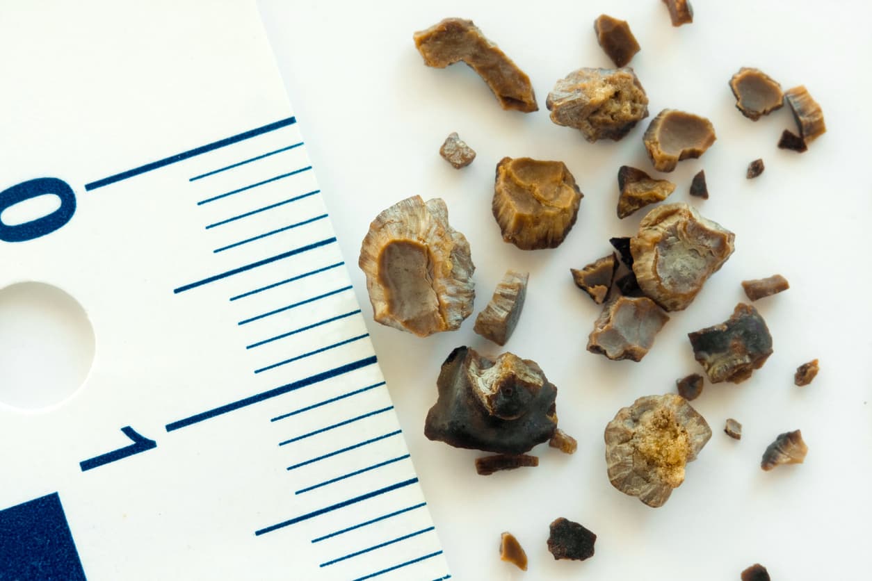Who is at risk of developing kidney stones?