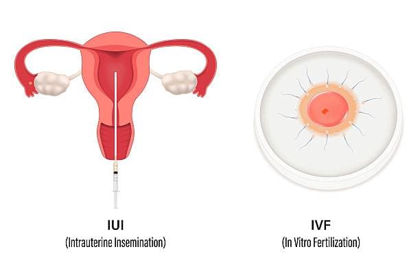 Key Differences between IUI and IVF