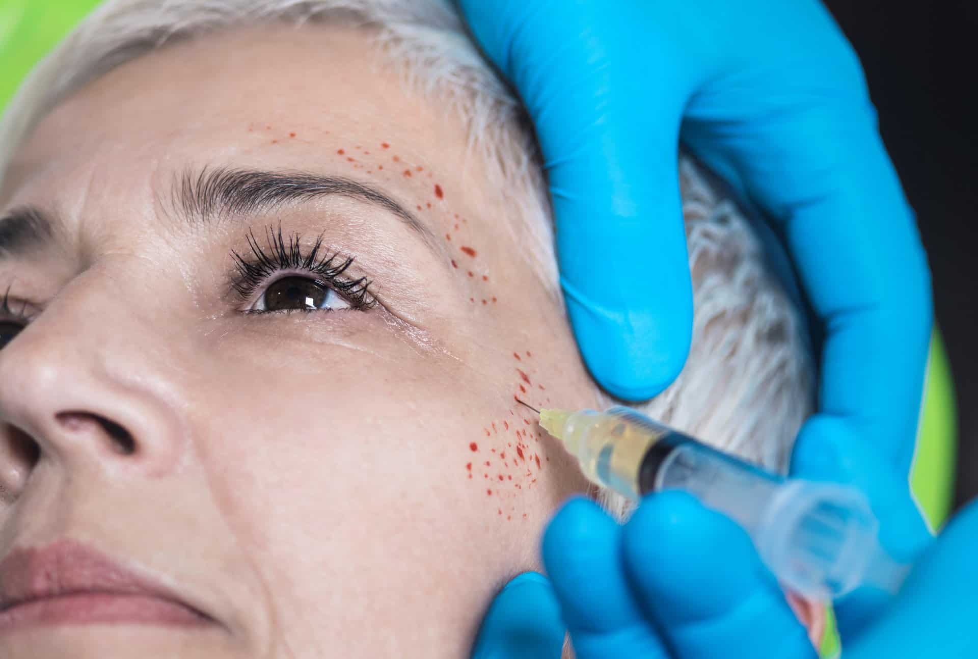 Microneedling with PRP (Platelet-Rich Plasma) Therapy