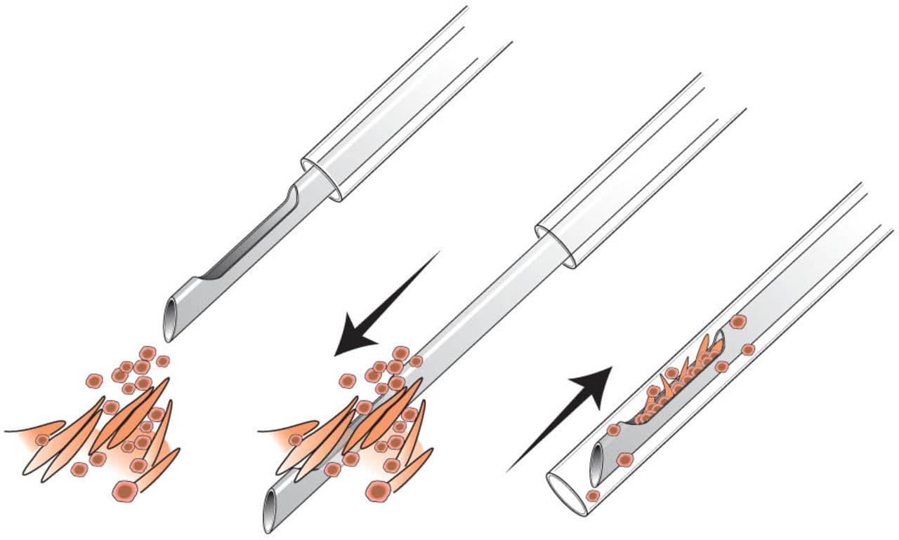 Core Needle Biopsy