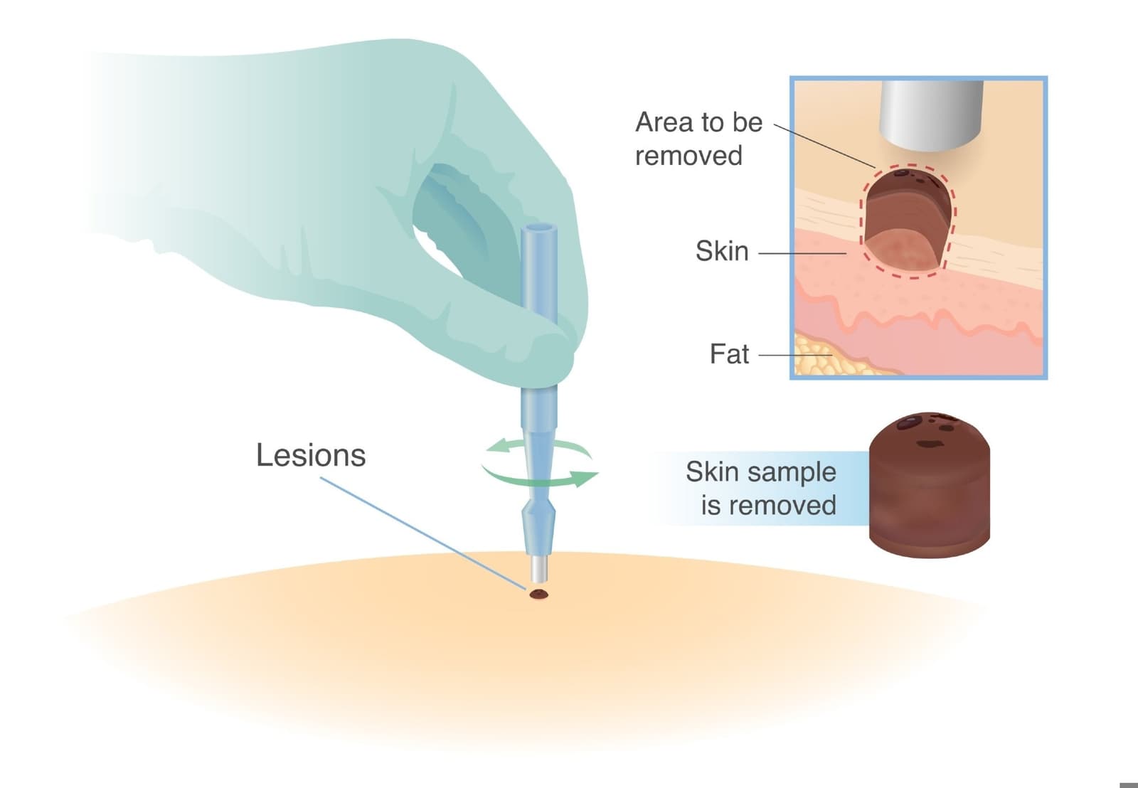 Punch Biopsy