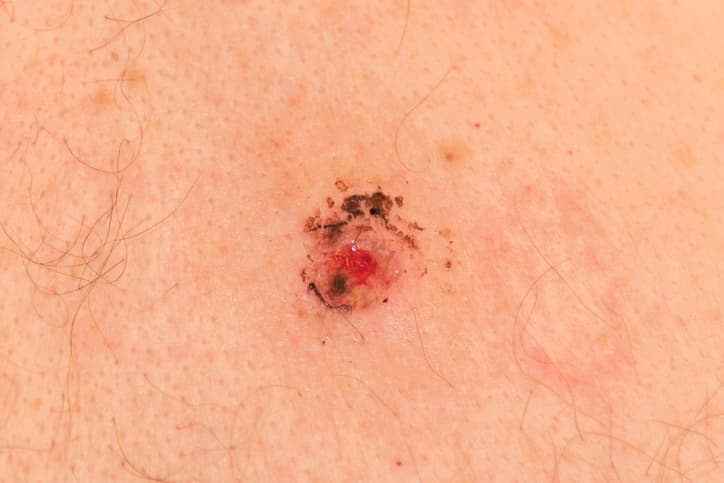 Shave Biopsy
