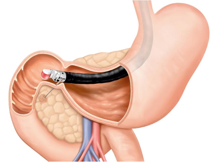 Endoscopic Biopsy