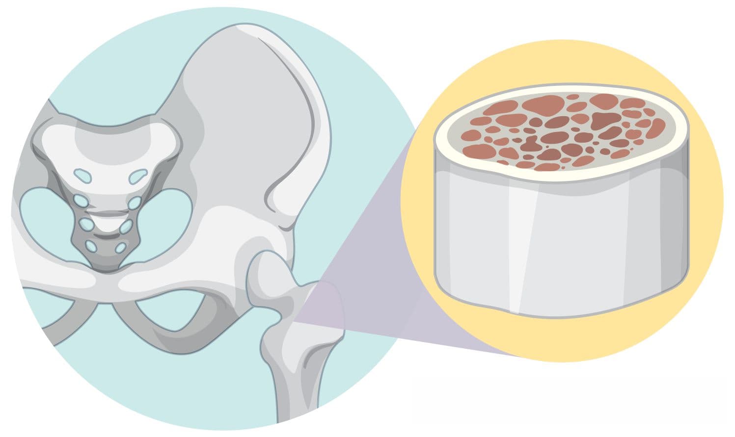 Bone Biopsy