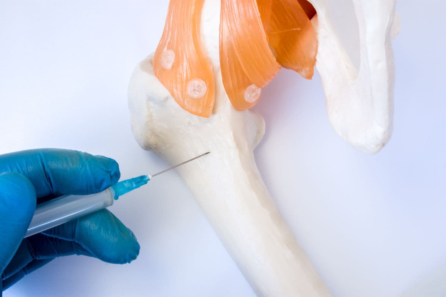 Bone Marrow Biopsy