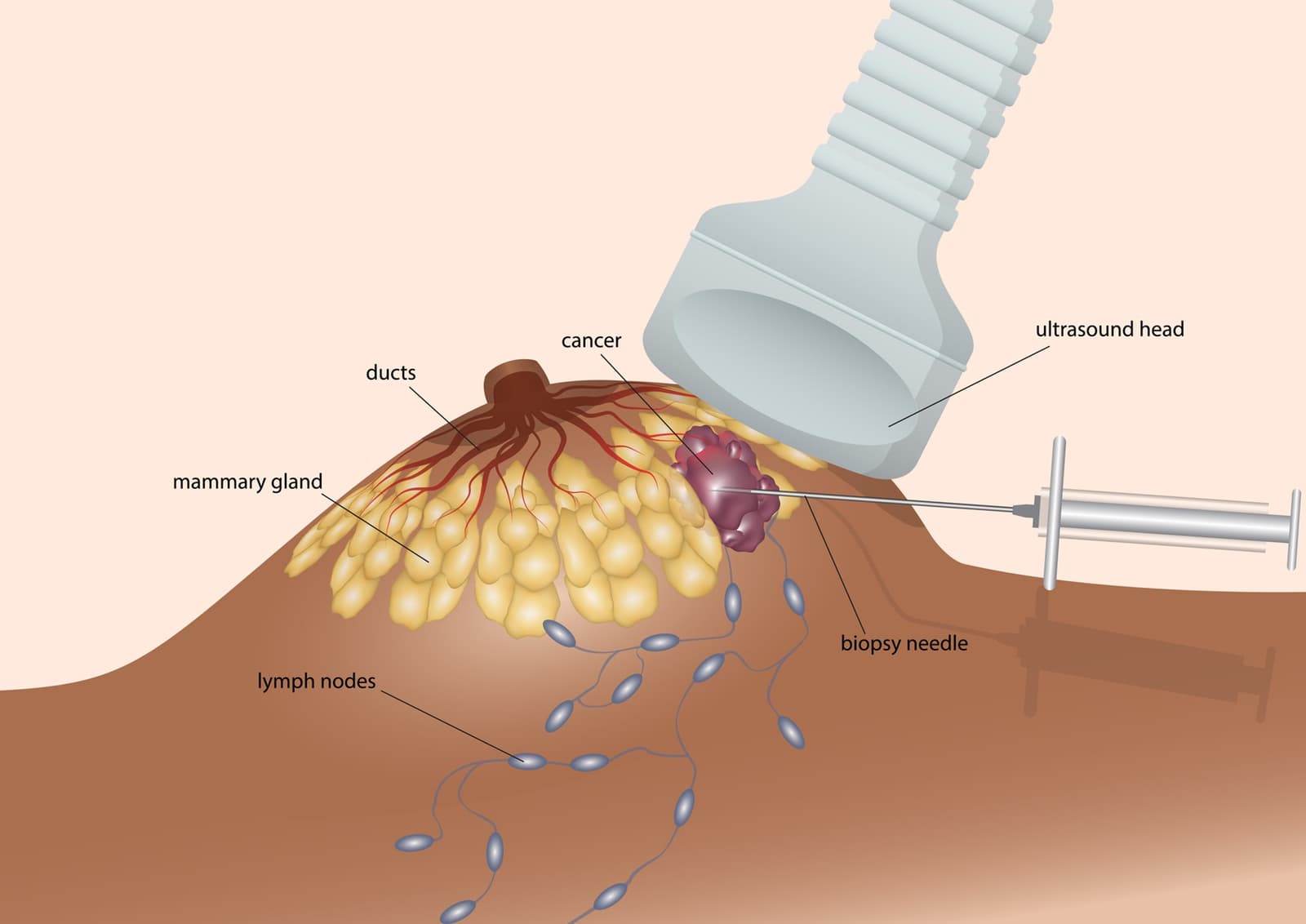 Lymph Node Biopsy