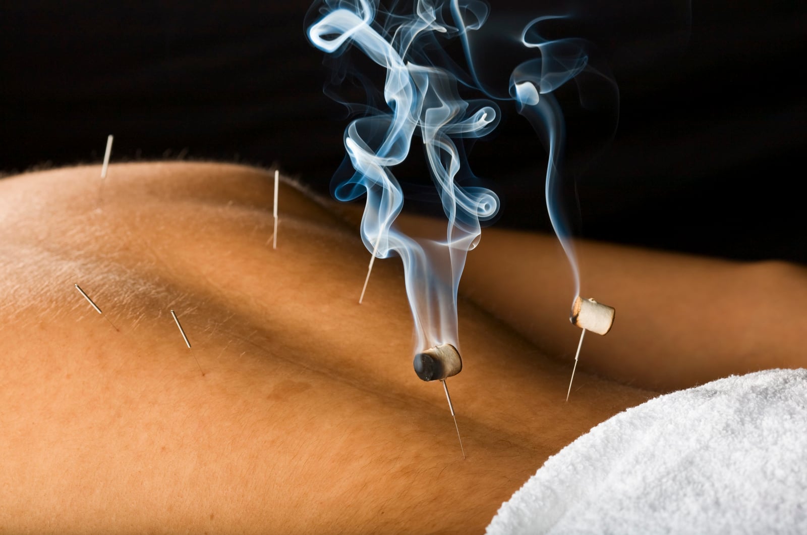 What are the pros & cons of Acupuncture?