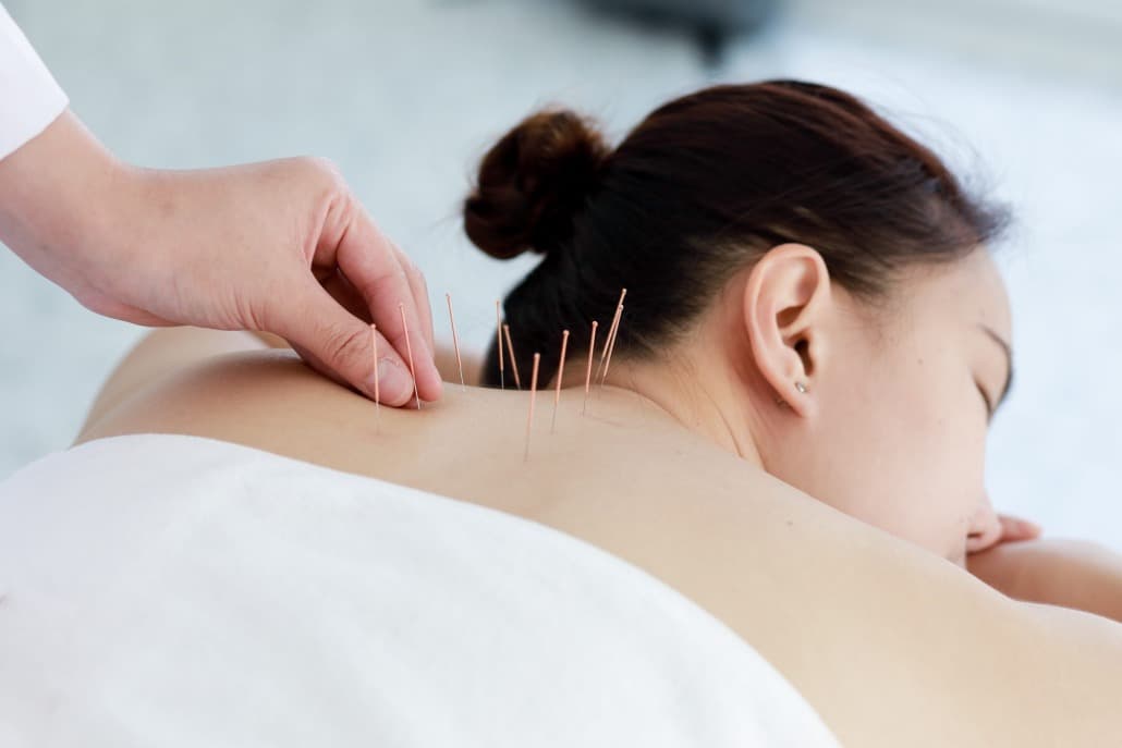 What Is Acupuncture?
