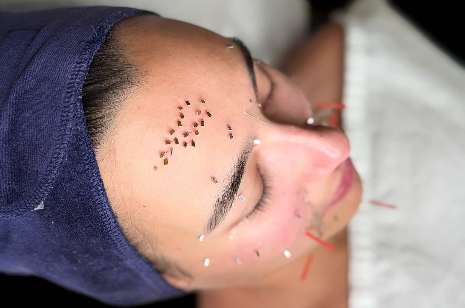 Is Acupuncture Right for You?