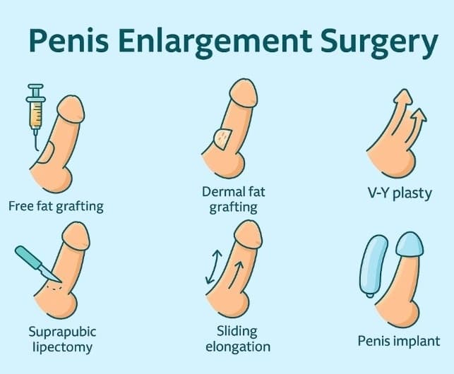 How Much Enlargement Can Surgery Provide?