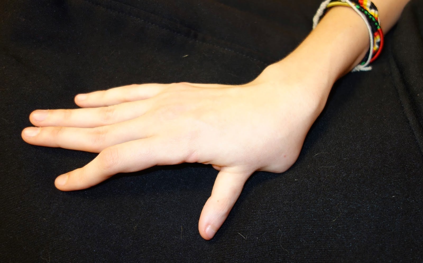 Types of Congenital Hand Deformities