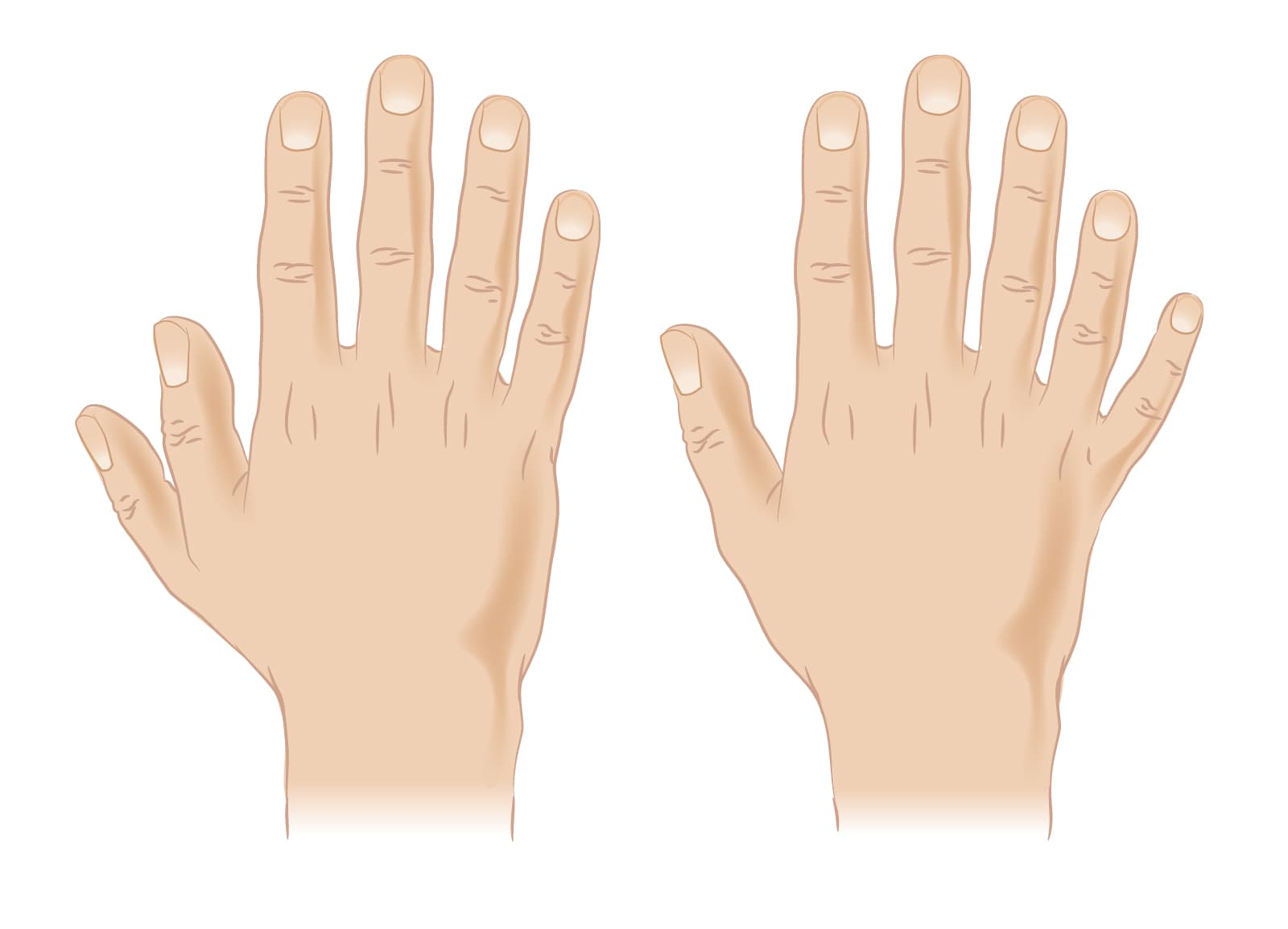 Congenital Hand Deformities
