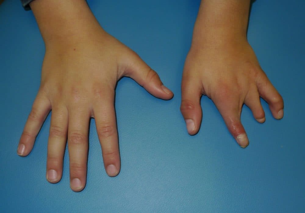 How Are Congenital Hand Deformities Diagnosed?