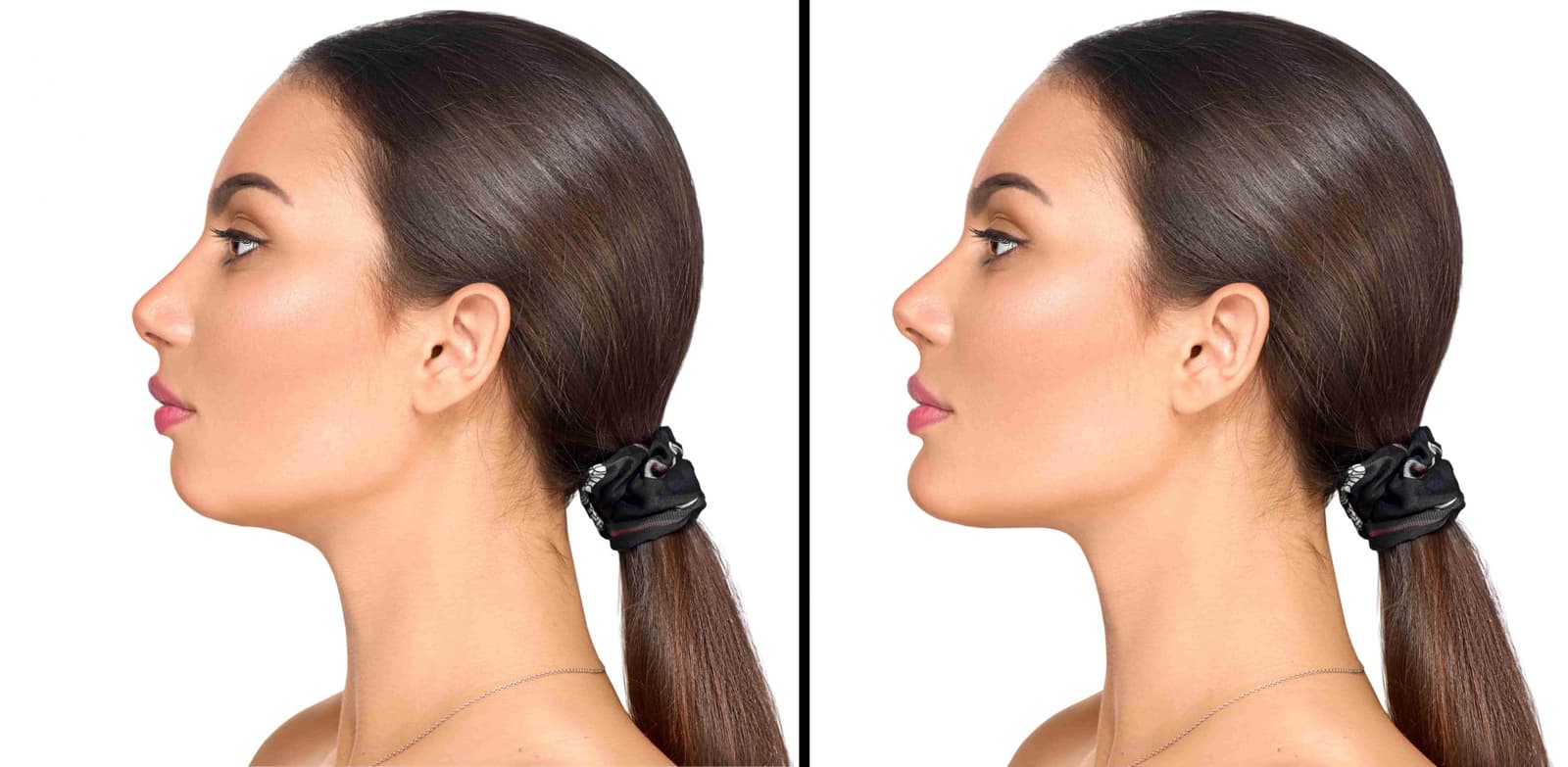 What Is a Chin Implant?