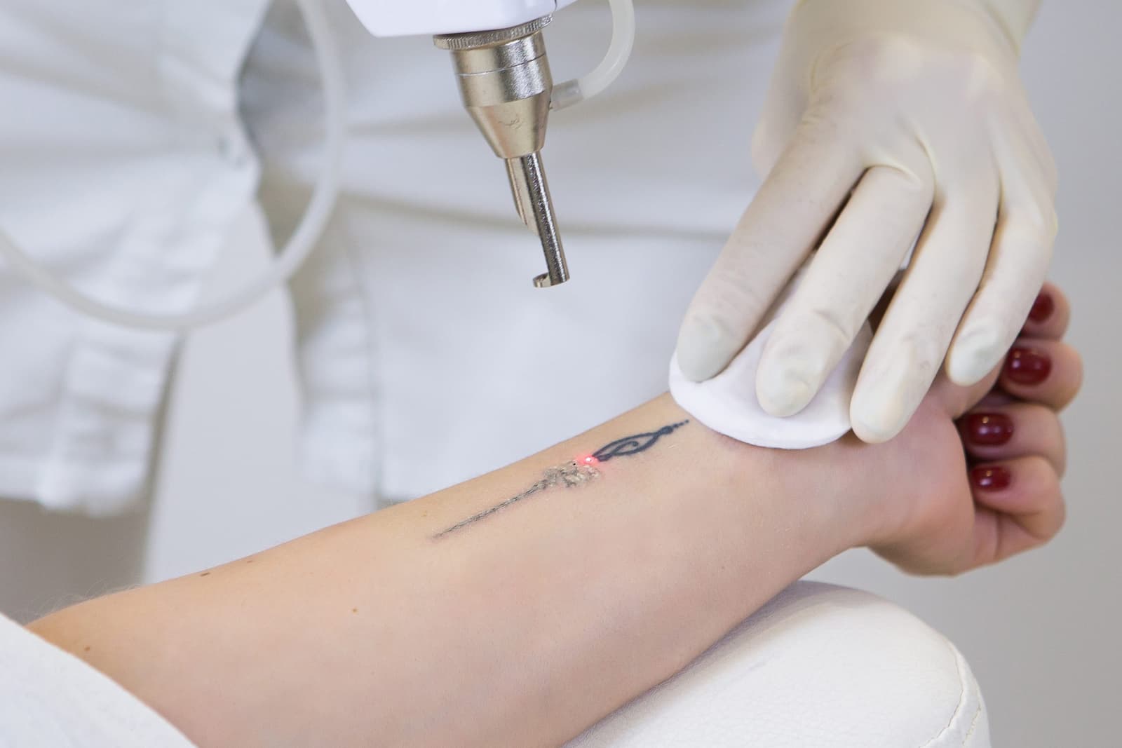Should Pain Determine Whether You Get or Remove a Tattoo?