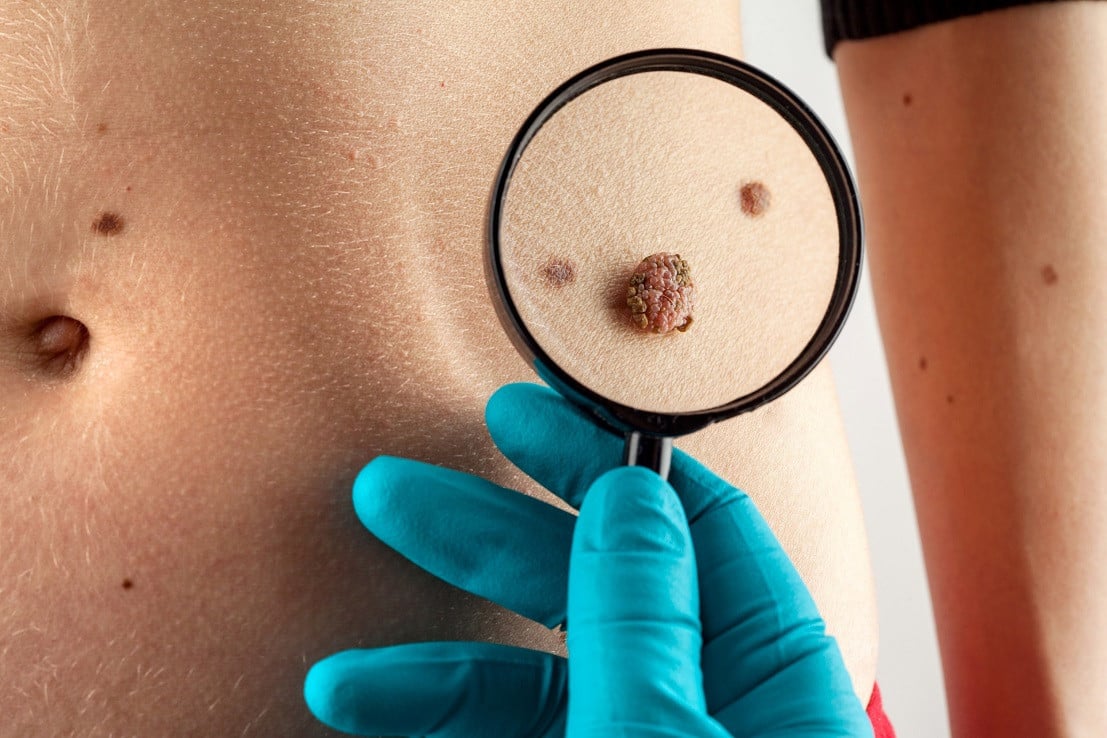 What to expect when you have a mole removed?