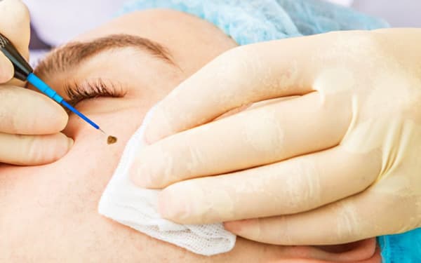 What Is Mole Removal Recovery Like?