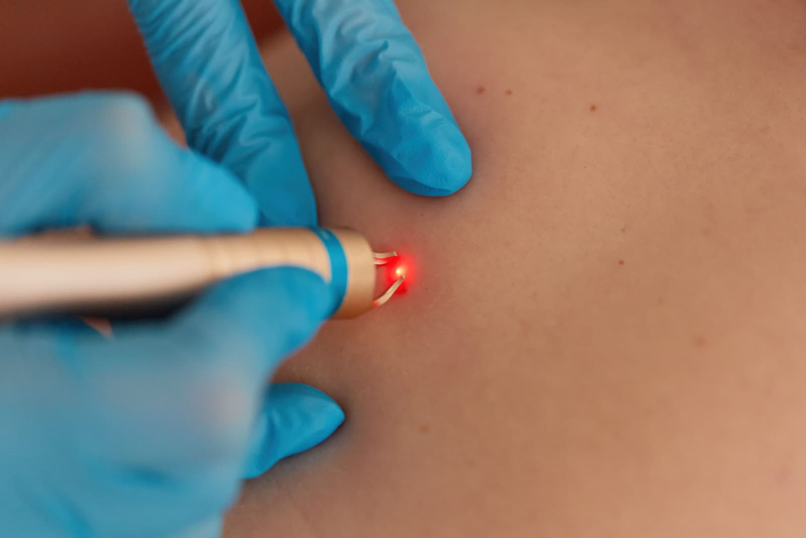What Is Laser Mole Removal?