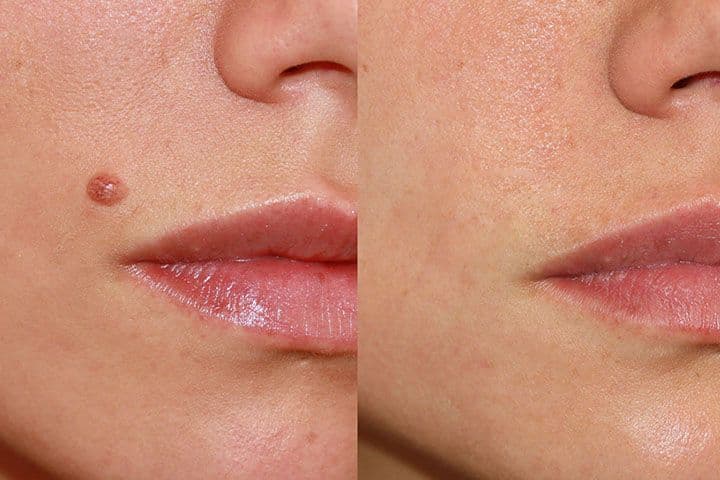 Which Method Is Better for Facial Moles?