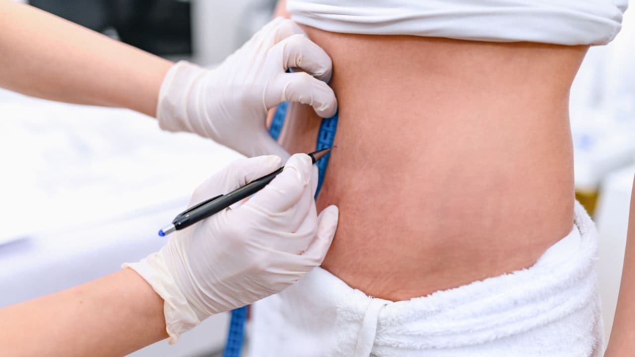 Topical vs. Injectable Carboxytherapy