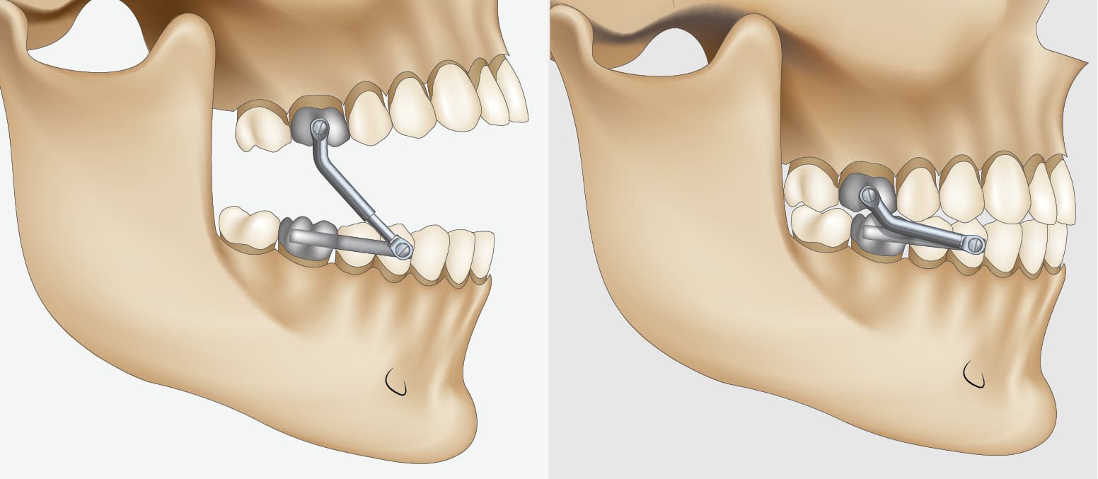 Dental and Bite Changes